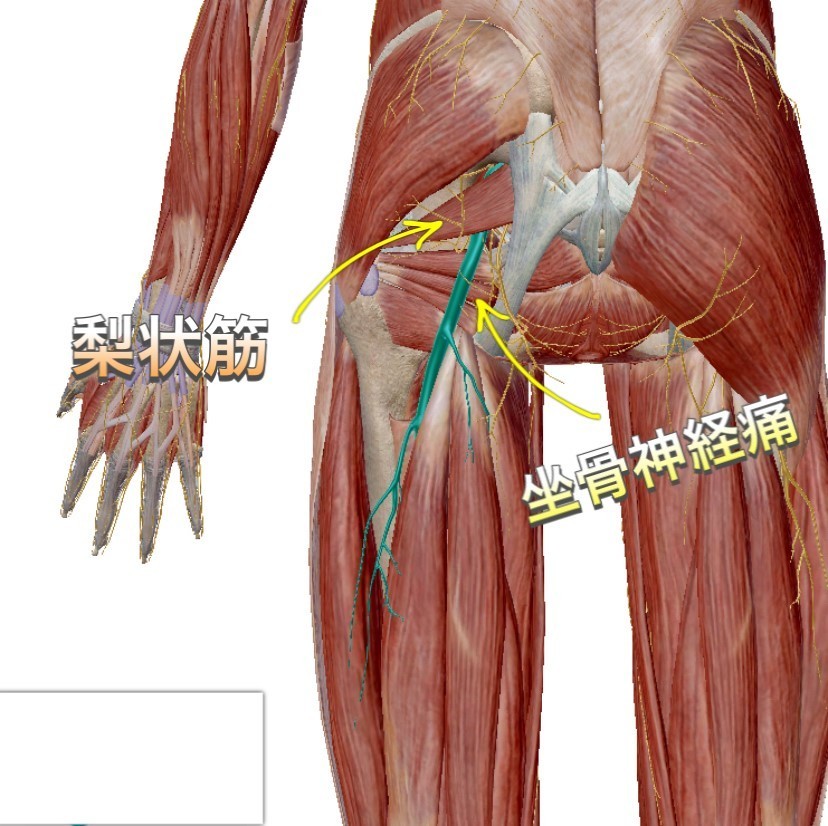 坐骨神経痛とは