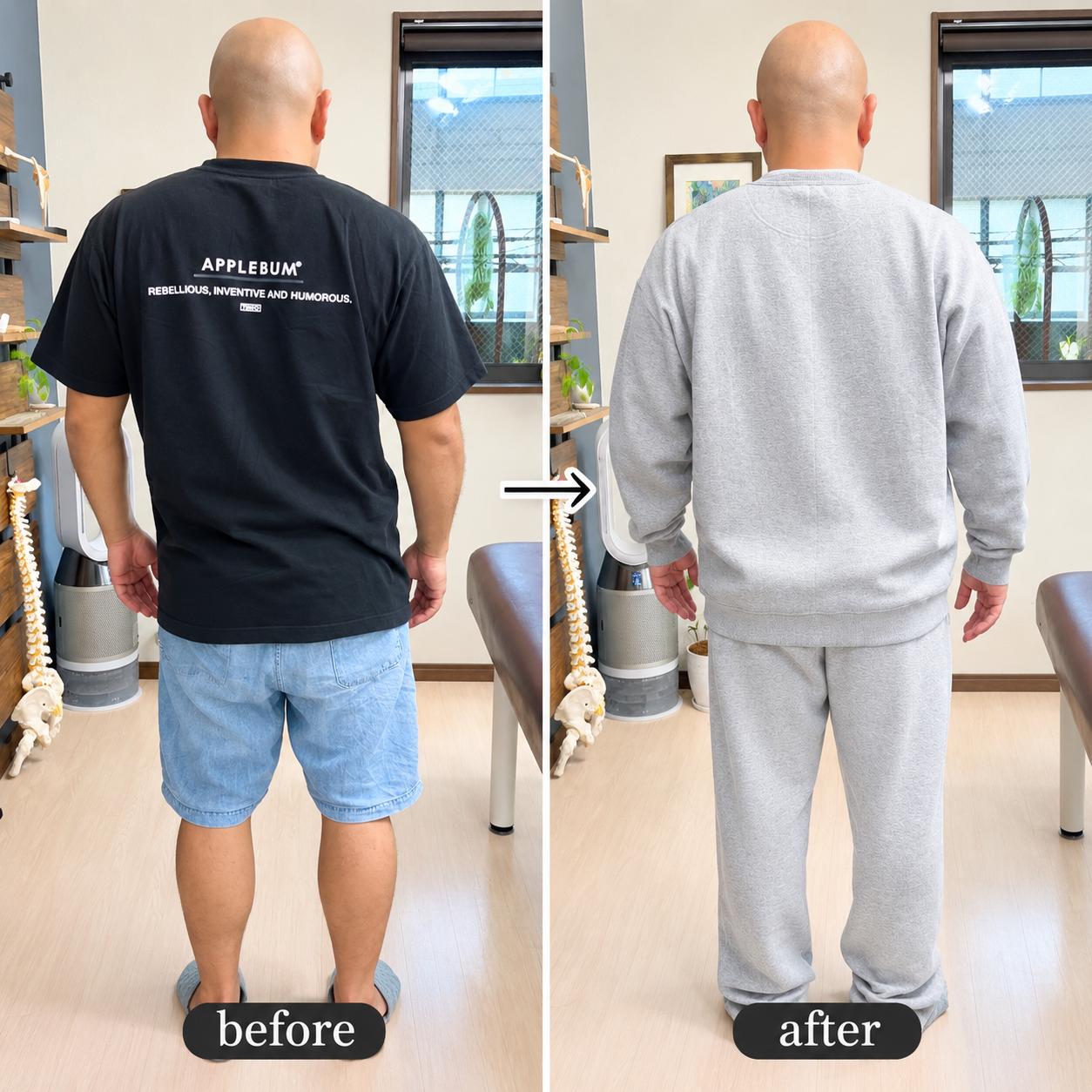 before/after 背骨の歪みが軽減