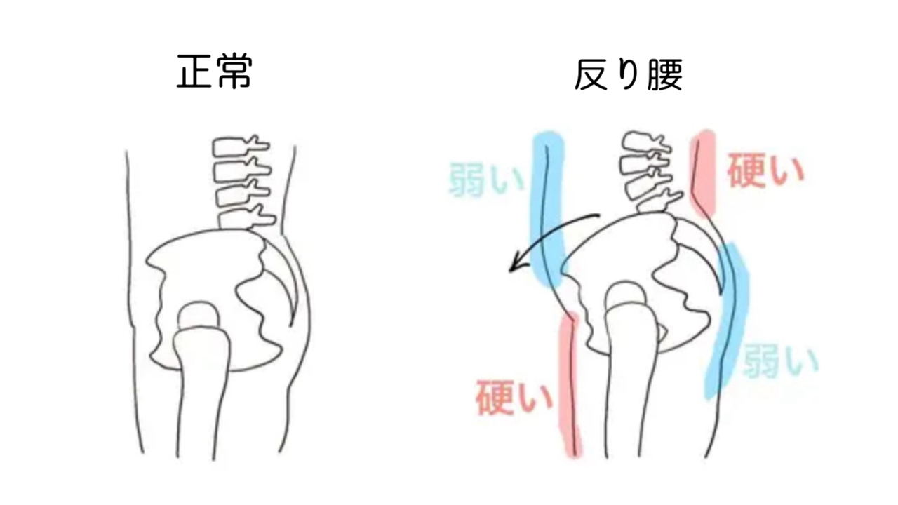 反り腰の主な原因