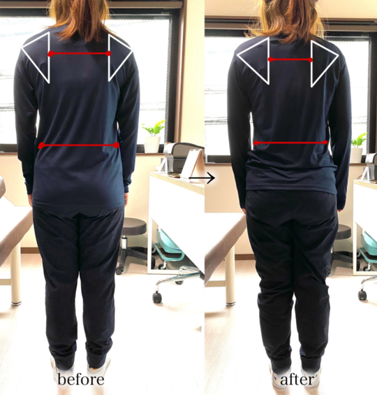 before/after姿勢が整い、肩幅やウエストが変化