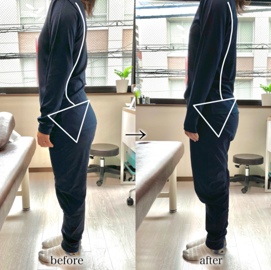 before/after反り腰が軽減し安定した骨盤に