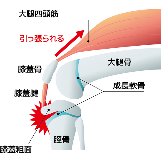 オスグッド病の原因