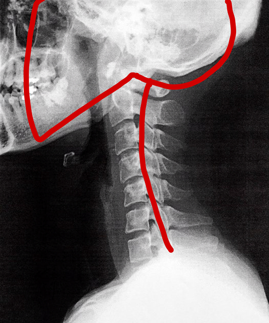 ストレートネックの原因についての解説