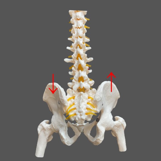 骨盤の上方・下方変異
